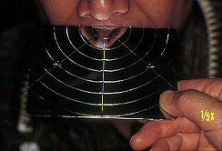 図3　PLP装置直後の鼻息鏡所見