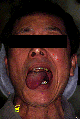 写真3　舌突出時の患側偏位