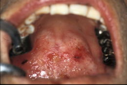 口腔ケアの症例5