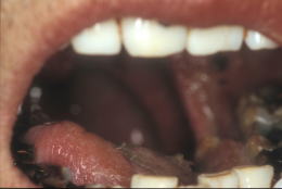 口腔ケアの症例8